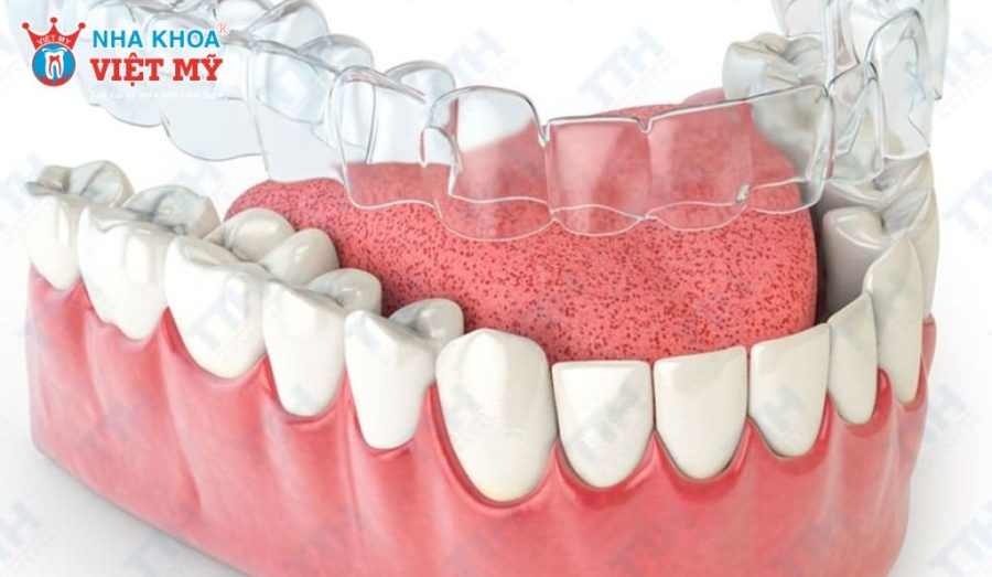 Invisalign là hệ thống niềng răng không mắc cài ứng dụng công nghệ khay trong suốt hiện đại, kiểm soát dịch chuyển răng chính xác. 