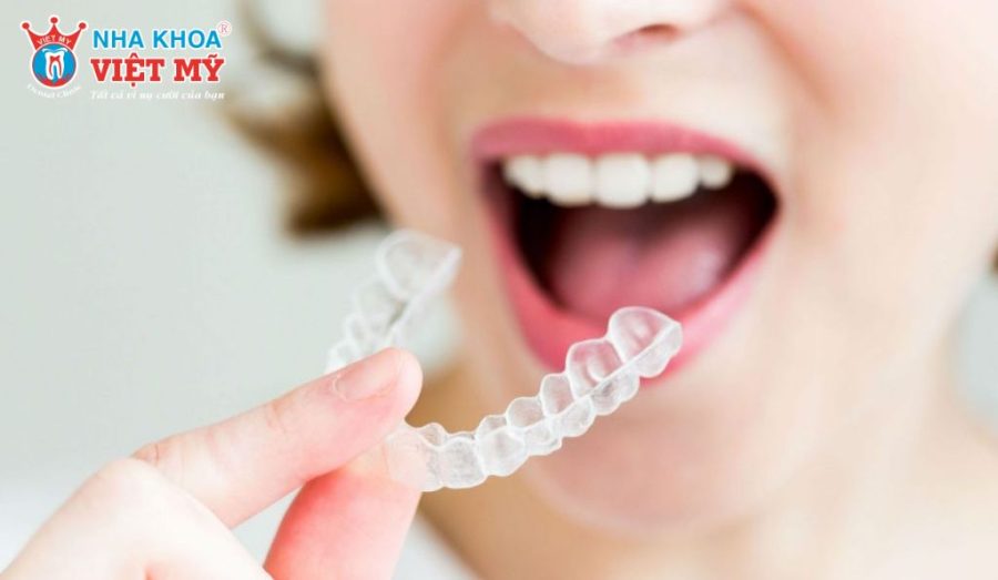 Niềng răng không mắc cài sử dụng khay trong suốt tạo lực dịch chuyển răng theo từng giai đoạn.