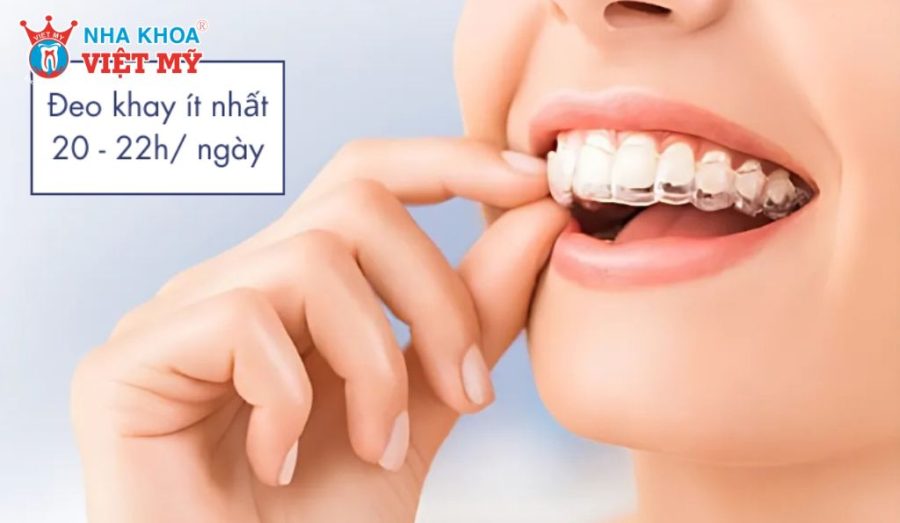 Người niềng cần đeo khay chỉnh nha tối thiểu 20 - 22 giờ mỗi ngày, chỉ tháo khay khi ăn uống và vệ sinh răng miệng