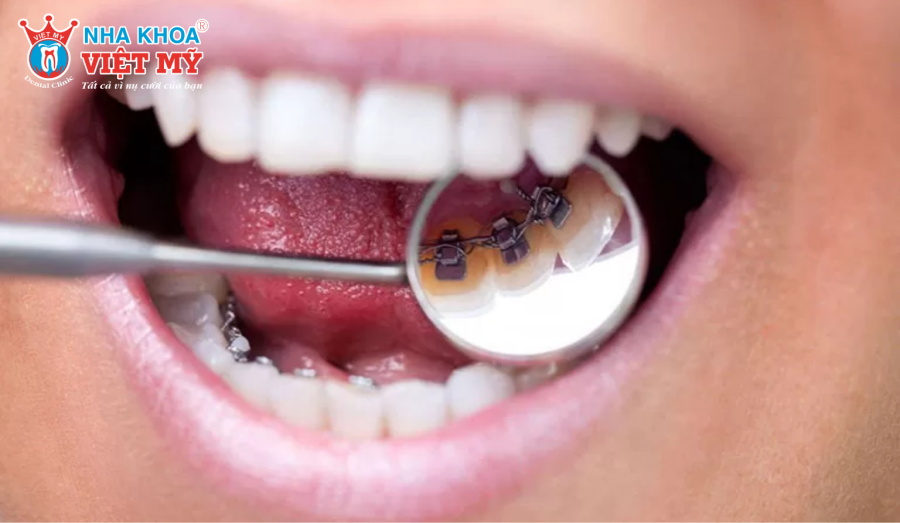 Niềng răng mặt trong giúp chỉnh nha hiệu quả và thẩm mỹ cao 
