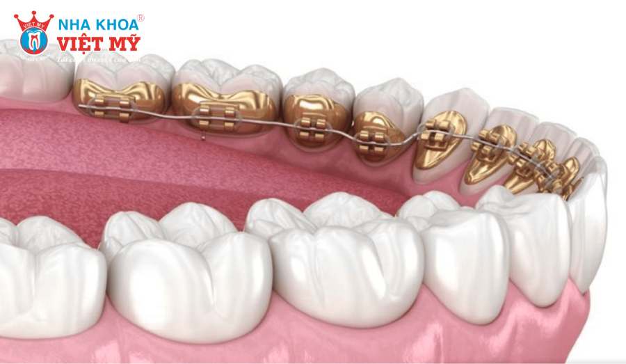 Niềng răng mặt trong có tính thẩm mỹ cao, hạn chế tổn thương môi má 