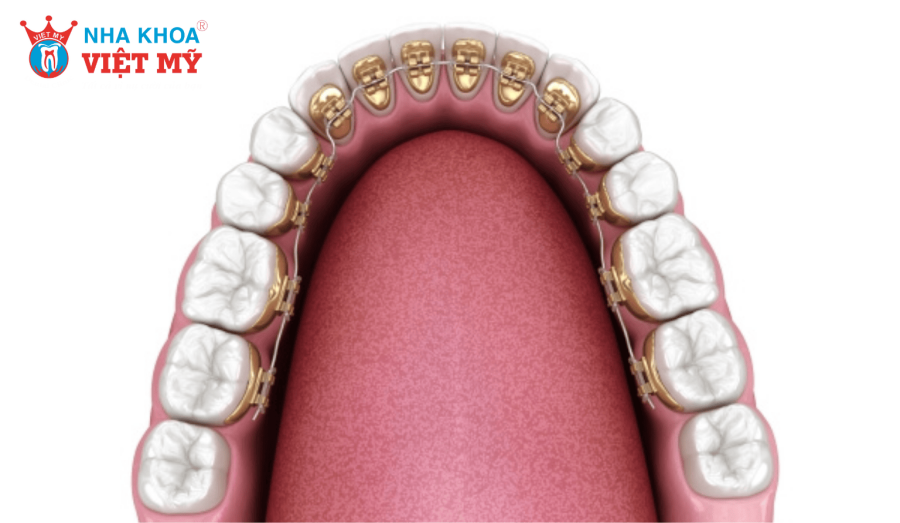 Chi phí niềng răng mặt trong dao động từ 85 - 115 triệu