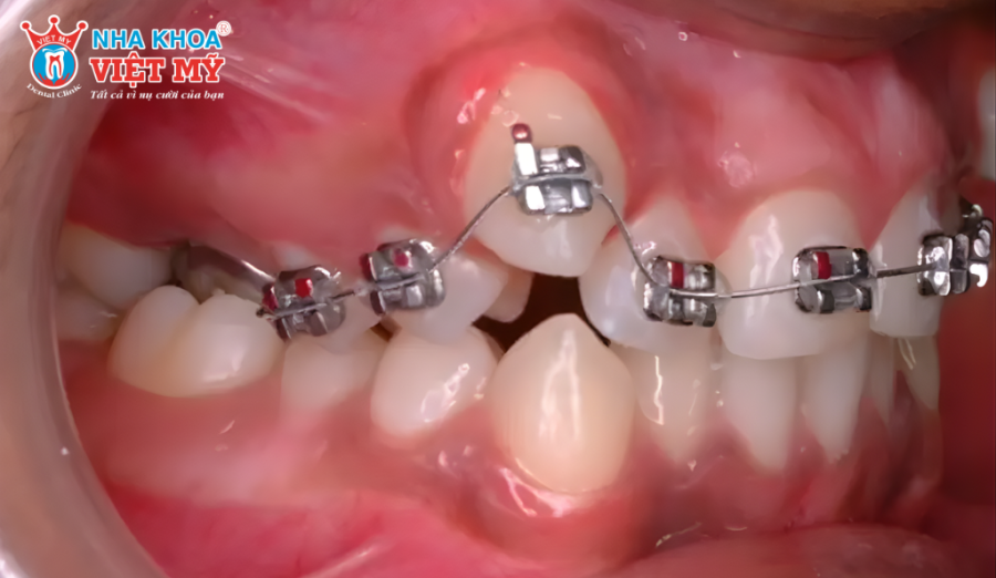 Niềng răng giúp đưa răng lệch về đúng vị trí
