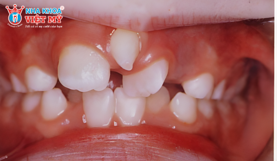 Răng trồi cao, lệch khỏi hàng răng tự nhiên