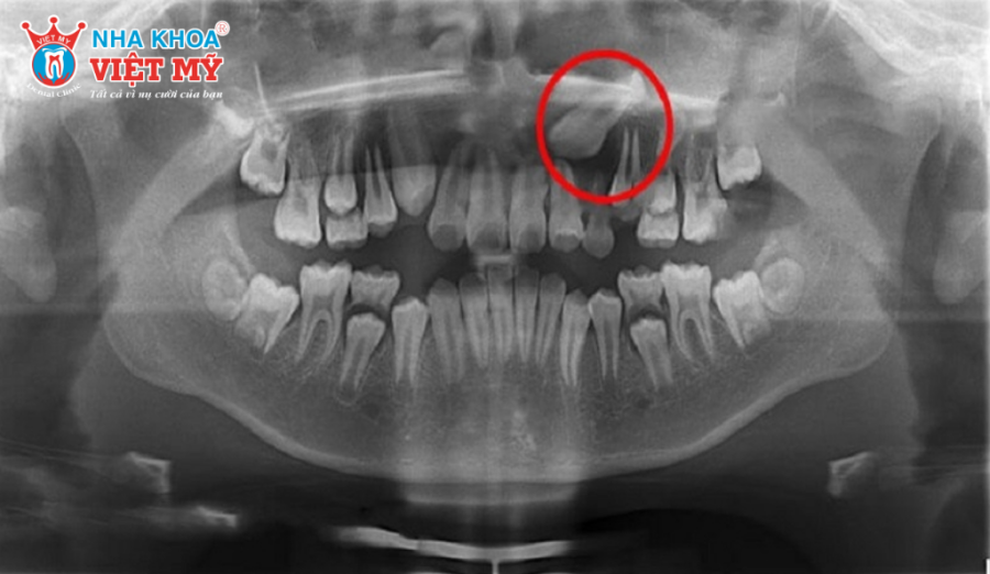 Răng mọc trên lợi hàm trên làm xáo trộn trật tự răng trên cung hàm