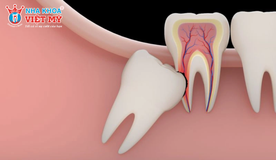 Răng khôn mọc ngược gây đau nhức và sưng viêm