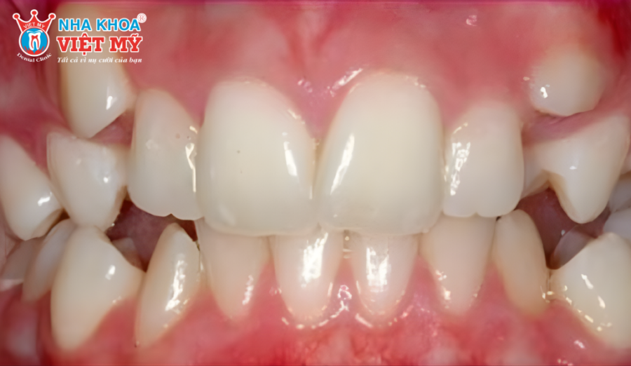 Răng mọc trên lợi hàm trên là tình trạng răng mọc sai vị trí trên cung hàm