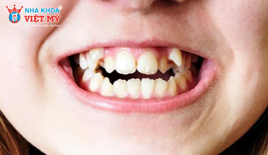 Răng mọc trên lợi hàm trên ảnh hưởng thẩm mỹ và chức năng ăn nhai