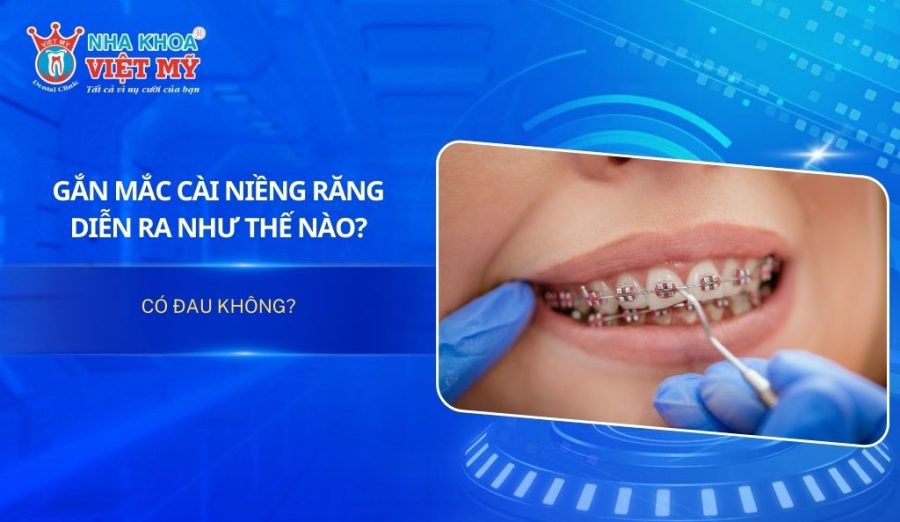 Gắn mắc cài niềng răng diễn ra như thế nào? Có đau không?