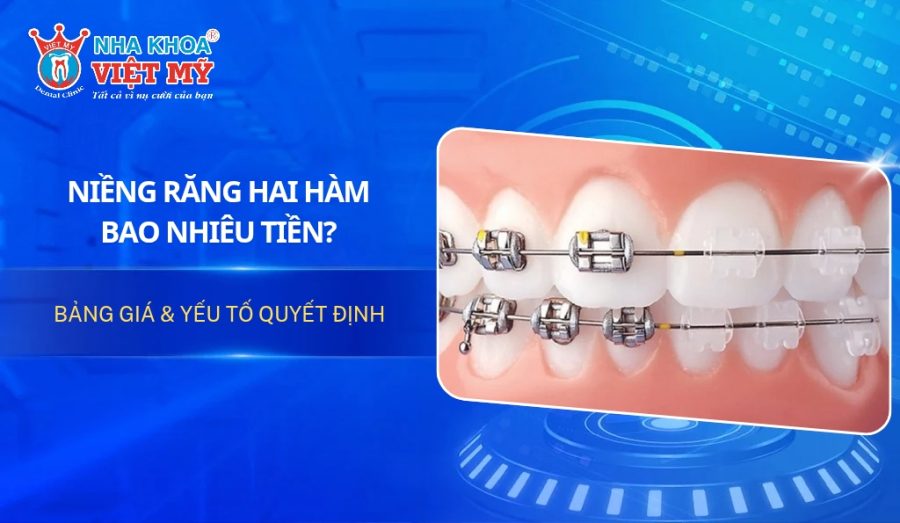 Niềng răng 2 hàm bao nhiêu tiền? Bảng giá mới nhất