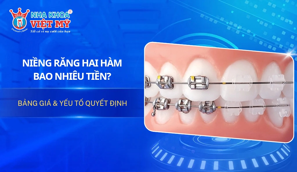 Niềng răng 2 hàm bao nhiêu tiền? Bảng giá mới nhất