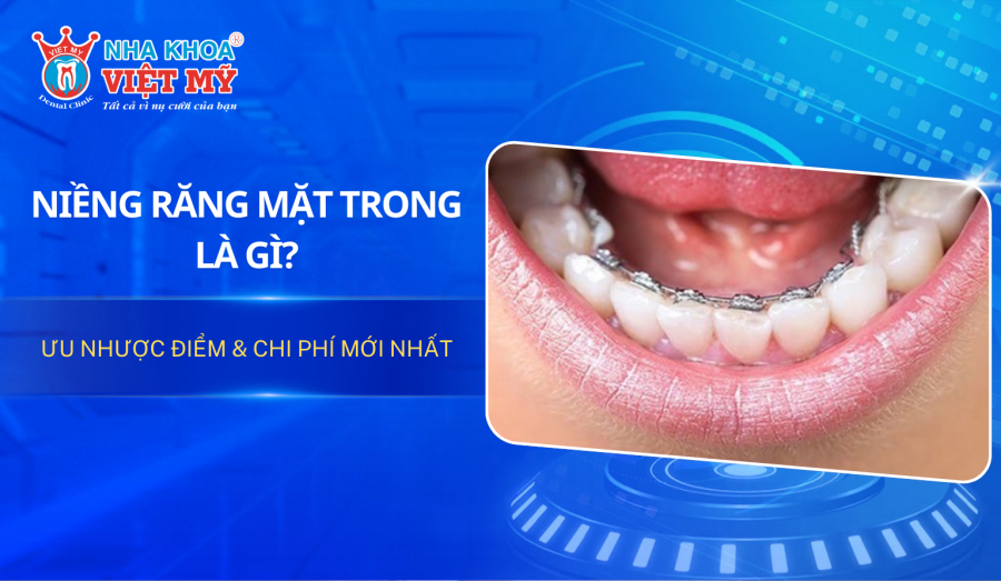 Niềng răng mặt trong là gì? Ưu nhược điểm & chi phí mới nhất