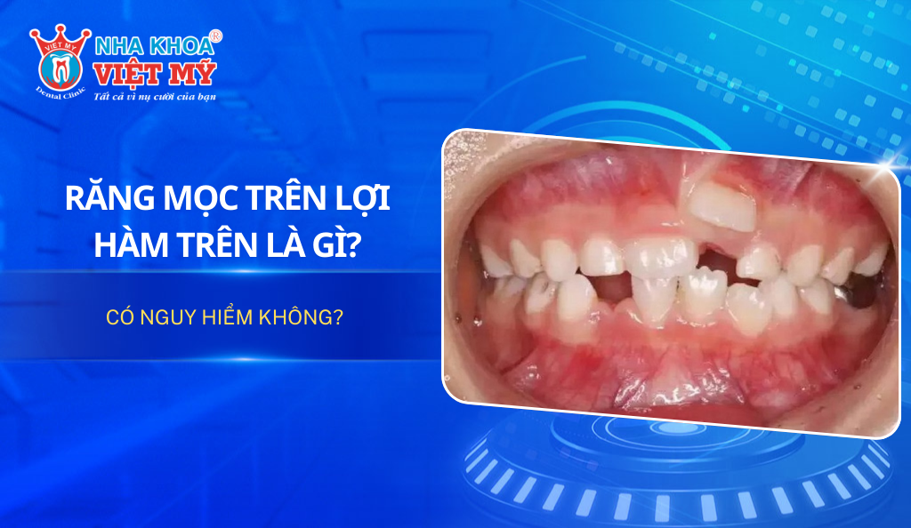 Răng mọc trên lợi hàm trên là gì? Có nguy hiểm không?
