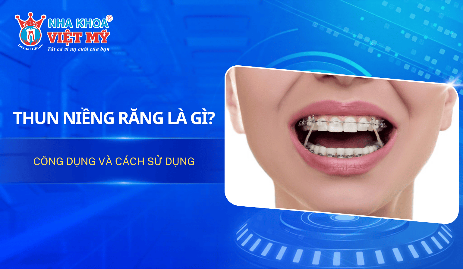 Thun niềng răng là gì? Công dụng và cách sử dụng