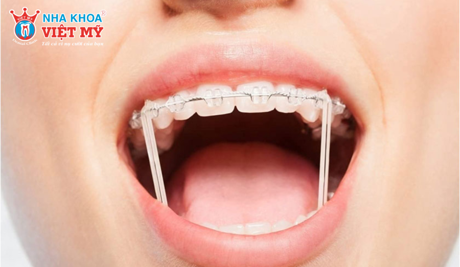 Thun niềng răng là những vòng cao su y tế có độ đàn hồi cao để tạo ra các lực kéo