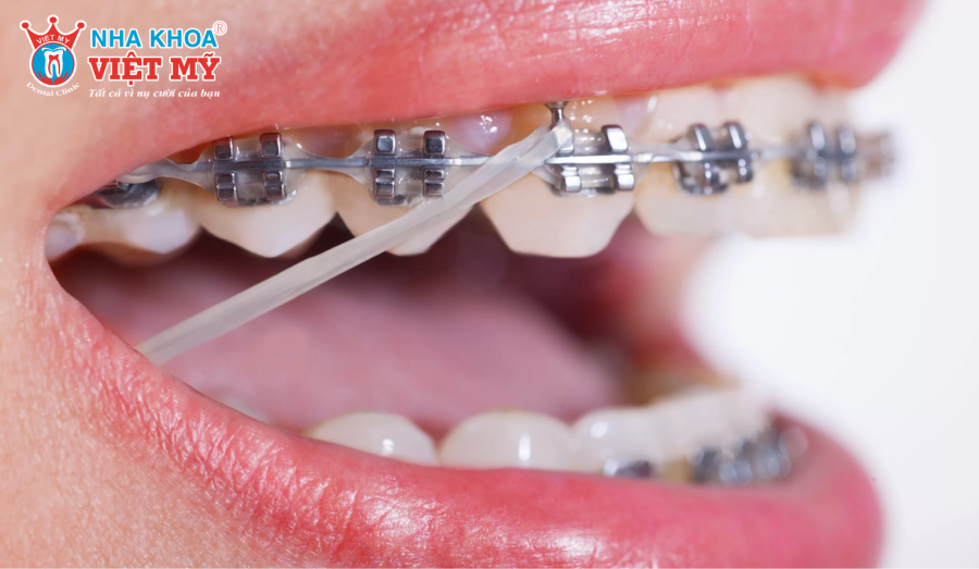 Thun liên hàm cần được đeo tối thiểu 20 - 22 tiếng/ngày