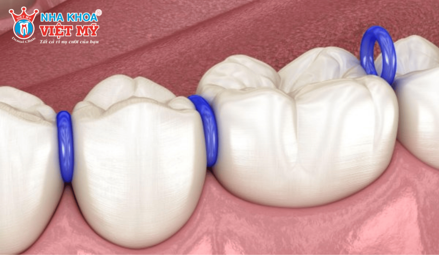 Thun tách kẽ giúp tạo ra khoảng trống giữa các răng hàm