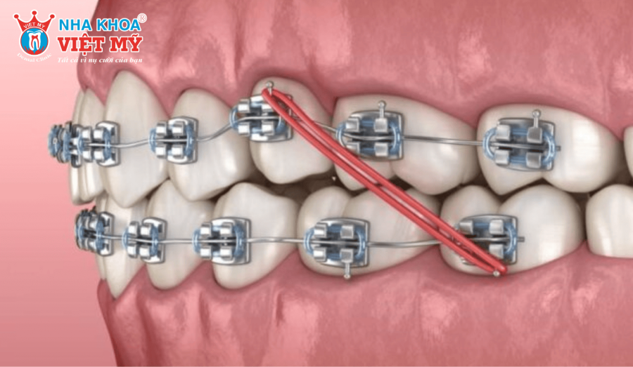 Chỉ có thể tự thay chun liên hàm