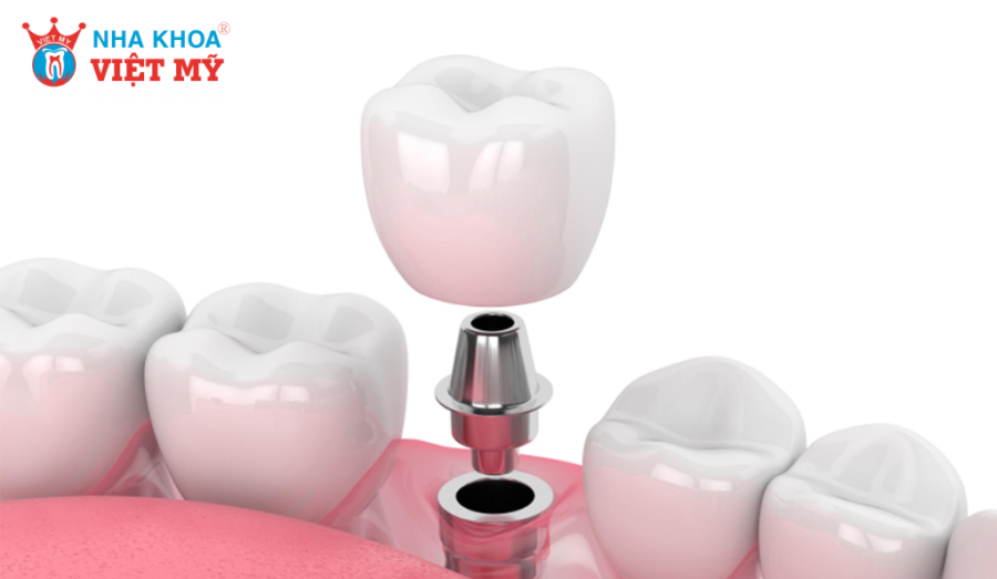  Trụ Implant Nobel Biocare có chất lượng vượt trội và xuất xứ từ Thụy Sĩ