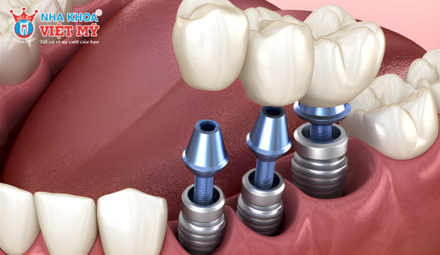 Hệ thống ren xoắn của trụ Implant MIS C1 giúp trụ được đặt vào xương hàm chính xác
