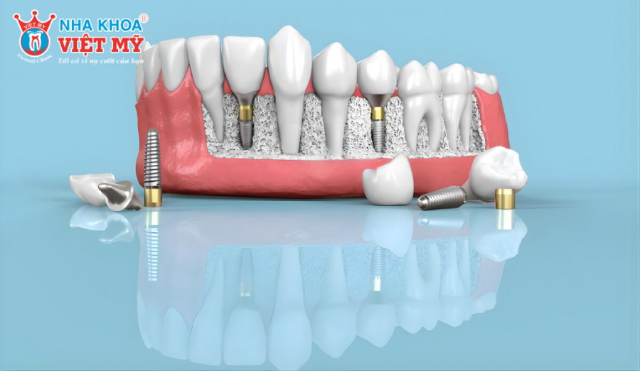 Chi phí trụ Implant MIS C1 thuộc phân khúc cao