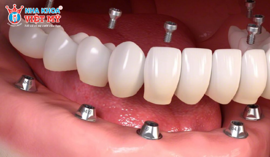 Giá thành của trụ Implant Tekka thường cao hơn các dòng trụ bình thường