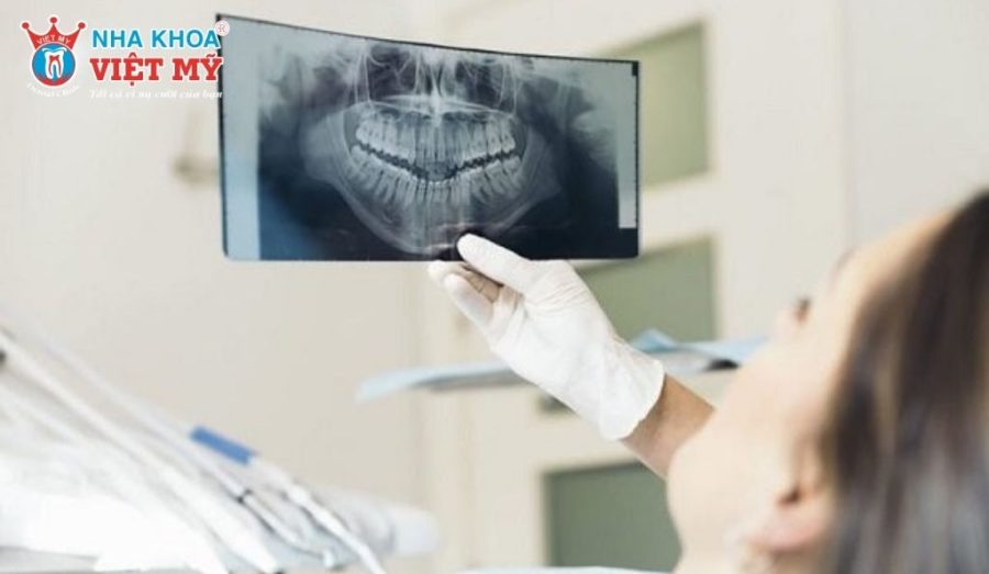 Chụp X-quang là bước quan trọng trước khi nhổ răng khôn, giúp bác sĩ đánh giá chính xác vị trí và mức độ phức tạp của răng