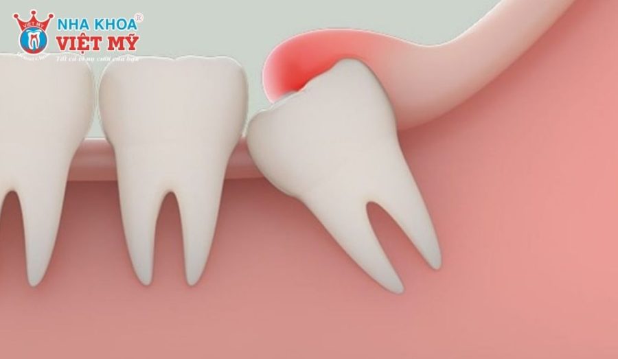 Răng khôn mọc lệch, mọc ngầm hoặc gây đau nhức kéo dài thường được bác sĩ chỉ định nhổ sớm