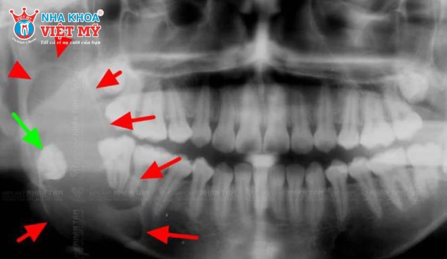 U men xương hàm phát triển chậm, không di căn nhưng có khả năng xâm lấn xương và gây biến dạng khuôn mặt nếu điều trị muộn.