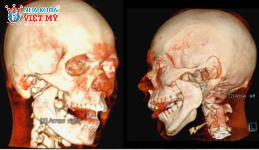 U men xương hàm được cho là liên quan đến sự tăng sinh bất thường của tế bào tạo men răng còn sót lại trong xương hàm.