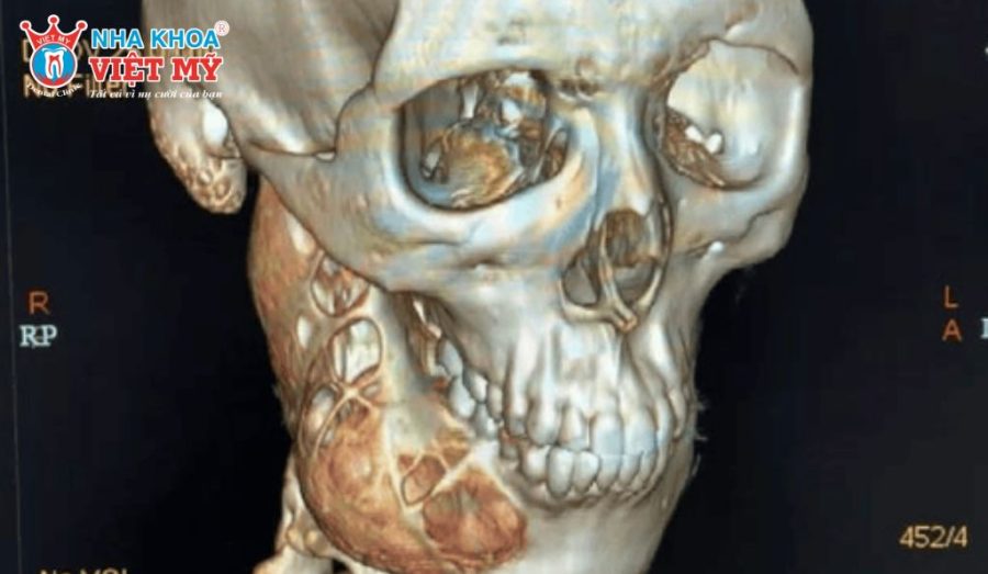 Phẫu thuật là phương pháp điều trị chính nhằm loại bỏ triệt để u men xương hàm và hạn chế nguy cơ tái phát.