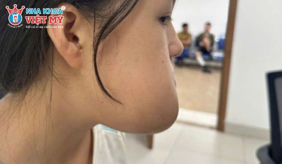 Điều trị u men xương hàm muộn có thể dẫn đến biến dạng khuôn mặt và ảnh hưởng lâu dài đến chức năng ăn nhai.