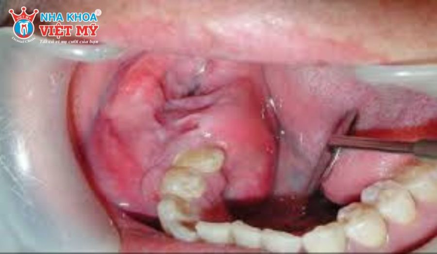 Một số nhóm đối tượng có nguy cơ cao mắc u men xương hàm cần theo dõi răng hàm mặt định kỳ để phát hiện sớm tổn thương.