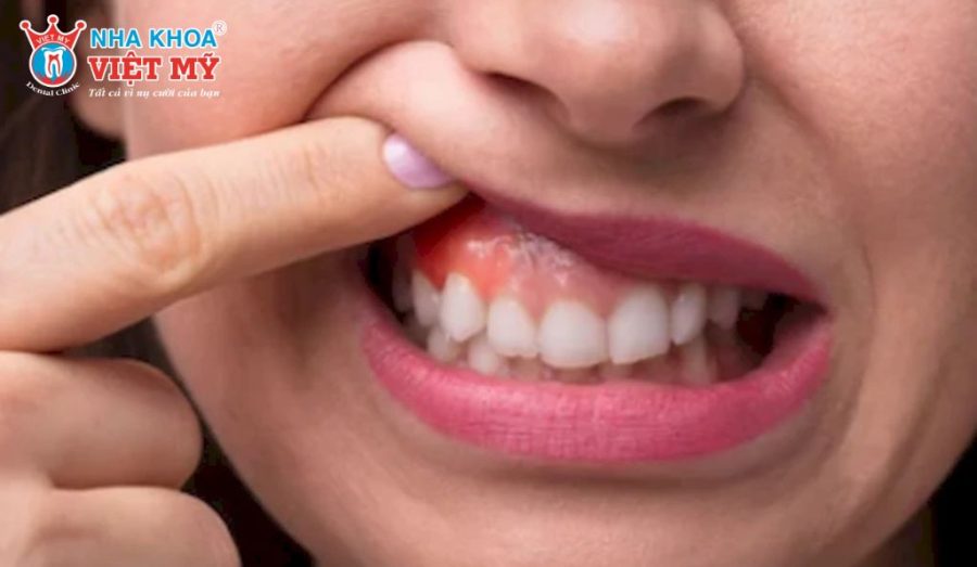 Ở giai đoạn đầu, u men xương hàm thường không gây đau và dễ bị bỏ sót nếu không thăm khám định kỳ.
