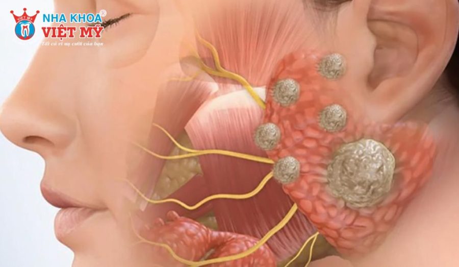 U men xương hàm được chia thành nhiều thể khác nhau dựa trên đặc điểm mô bệnh học và mức độ xâm lấn.