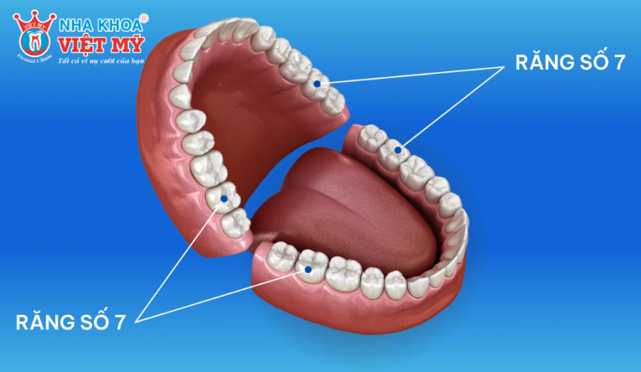 Thiếu mất răng hàm số 6, 7 gây nên nhiều vấn đề nghiêm trọng cho răng miệng