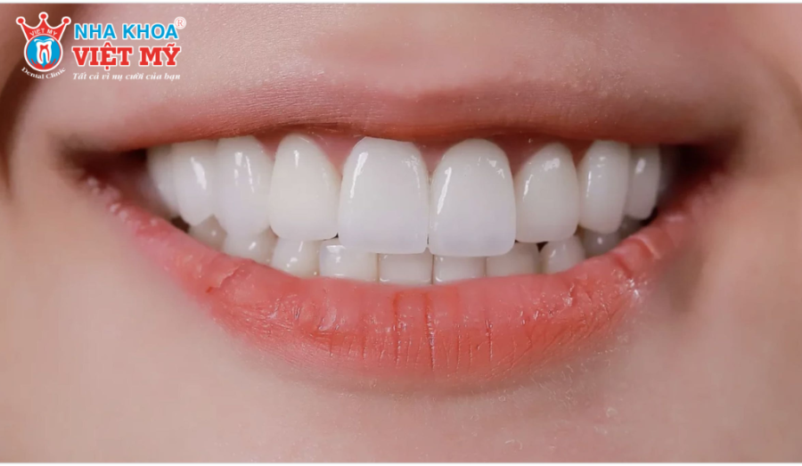Sự khác biệt giữa người 28 và 32 răng có sự ảnh hưởng đến chức năng và thẩm mỹ