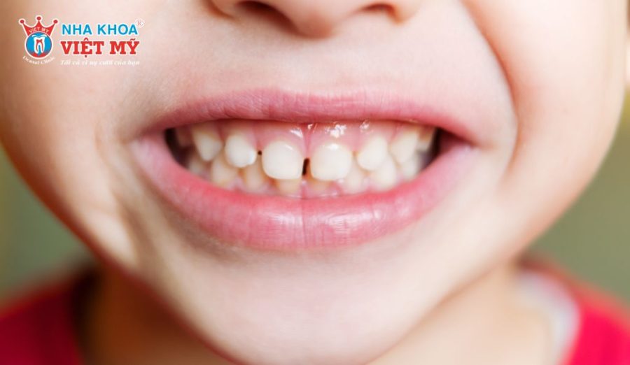 Đến khoảng 3 tuổi, hầu hết trẻ sẽ có đầy đủ 20 chiếc răng sữa